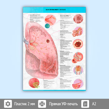 Плакат «Заболевания легких» (М-30, пластик 2 мм, A2, 1 лист)